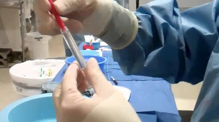 Onyx syringe preparation- Vanderbilt Neurovascular Surgery